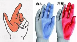 超全详解:腕管综合征的康复指南
